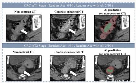 阿里发布AI模型助力肠癌早期筛查